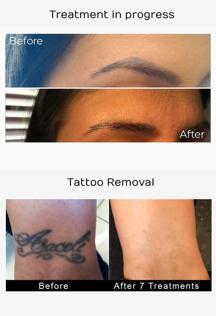 Tattoo Removal Los Angeles - Laser Tattoo Removers